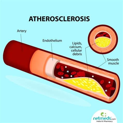 atherosclerosis bing images.